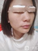 心心念念的雙眼皮終于是做完了，對(duì)自己的雙眼皮一直以來(lái)都是特別的不滿(mǎn)意