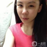 因為我自己身上的脂肪不是太多，所以醫(yī)生看到我這樣的面部直接給我推薦的是