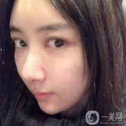 做完面部填充手術(shù)已經(jīng)半年的時間了，現(xiàn)在我的臉部脂肪已經(jīng)穩(wěn)定下來了