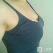 在隆胸拆線之后幾乎我就恢復了正常的生活了，也可以正常的洗澡了，就是需要