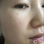 做完皮秒祛斑已經(jīng)是第15天了，做這個(gè)皮秒之前，會(huì)給你打麻藥，不用擔(dān)心疼