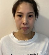 做完皮秒，我的臉白得像個(gè)帶殼的雞蛋，激動(dòng)~