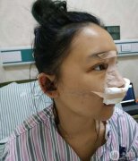 總覺得鼻子眼睛真的需要改良，鼻子不明顯，所以做了手術(shù)