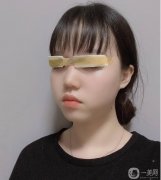 我是懶癌患者，據(jù)說貼雙眼皮貼不好，我的眼皮很容易松弛，權(quán)衡利弊，還是割