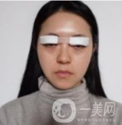 我來(lái)了，我來(lái)了，做的眼綜合，半個(gè)月才拆線 效果很好