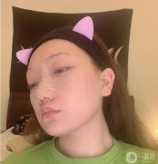 今天是術(shù)后第七天，縫線已經(jīng)拆線，醫(yī)生說(shuō)恢復(fù)的不錯(cuò)