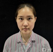 我的鼻子做了，前兩天沒(méi)敢洗臉
