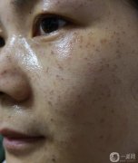 做的蜂巢皮秒祛斑，恢復(fù)期間都比較黑，看起來(lái)有點(diǎn)不好看
