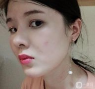 臉部的腫脹在慢慢減輕，淤青也在消失，越來越正常