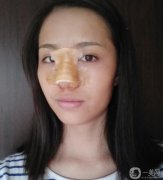 鼻子還在恢復(fù)中,還是有點(diǎn)硬，手感還沒(méi)有達(dá)到自然