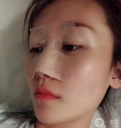 鼻部修復(fù)第7天醫(yī)生說我恢復(fù)的很好,越來越羨慕自己，不知道當(dāng)初的勇氣是從哪