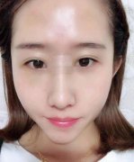 一直對自己的鼻子不滿意,雖然挺高，但是肉多