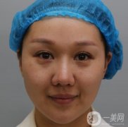 剛做完熱瑪吉的這幾天皮膚有一些緊致，臉看起來也是小了許多