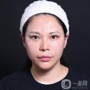 面部拉皮手術(shù)的第二天，臉上有強烈的緊繃感覺