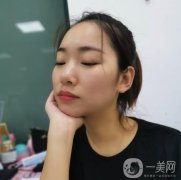 做完拉皮手術(shù)之后，還有些瘦臉型的效果