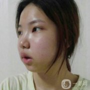 做了面部拉皮手術(shù)之后，感覺自己又回到了20歲的時候的肌膚