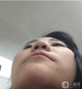 隆鼻術(shù)后兩個(gè)月，鼻子的高度剛剛好
