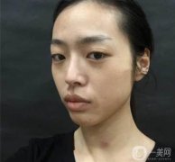 隆鼻術(shù)后一個(gè)月，鼻子大小弧度都還行