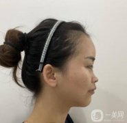 隆鼻時(shí)，美容效果可以更自然