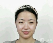 面部脂肪填充后半個(gè)月，臉就飽滿了