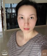 我以前做過鼻子整形，但我不滿意