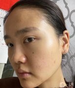 做完鼻子后，感覺效果出來了，鼻翼小很多