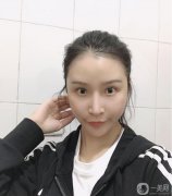 減脂很難，也瘦不了多少，所以面部吸脂真的幫了我很多