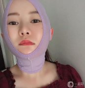 我在下部做了吸臉和線雕，解決了臉上脂肪厚度和皮脂下垂的問題