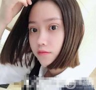 做完眼綜合手術(shù)已經(jīng)有二十多天的時(shí)間了，眼睛消腫得越來越快了