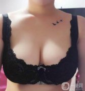 在嚴(yán)重的情況下對女性泌乳后期也有一定的影響，所以副乳切除是重要的