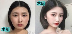 因?yàn)槲业难劬Σ恢罏槭裁纯雌饋砟敲床辉冢劬Φ拈L和寬也不是我想要的