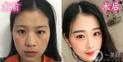 我一直不太喜歡我的大鼻子，它看起來又扁又平，沒有弧度