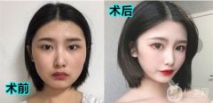 術(shù)后16天，拆線后眼睛真的恢復(fù)的比較快