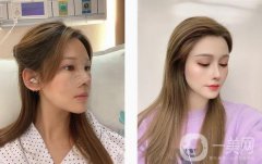 想了很久，攢了很久的錢，終于如愿在醫(yī)院做了個鼻子