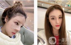 現(xiàn)在鼻子弧度還是很好的，山根自然消失，在原來(lái)的基礎(chǔ)上增加1 mm以上