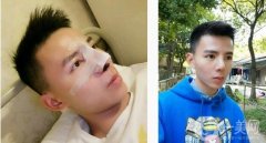 來醫(yī)院面診后，醫(yī)生給我做鼻子合成的建議，腫脹的耳軟骨墊托起了鼻子鼻頭縮
