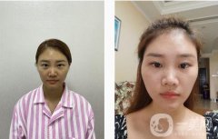 埋線雙眼皮手術后，我覺得每天照鏡子成了我不可或缺的例行公事