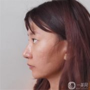 做完雙眼皮手術已經好幾天了
