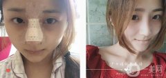 鼻部手術后15天，近能用洗面奶洗臉，然后出門活動會畫眼妝和唇妝，但不使用