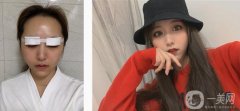 要做雙眼皮手術，很多朋友都說我做了雙眼皮手術以后是大美女