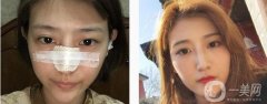 所以很多人對(duì)自己的鼻子不滿意，甚至有人選擇做隆鼻來(lái)達(dá)到美觀的效果