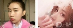我做了一次全面的鼻子整形手術(shù)，因?yàn)槲铱傆X(jué)得鼻子塌在山根，整個(gè)鼻子看起來(lái)