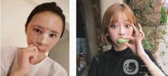 之前想了很久，由于實(shí)在不喜歡自己的鼻子，影響了自己的整體形象，所以來(lái)做
