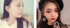 一直對(duì)自己的鼻子不是特別滿意，后來(lái)查了很多醫(yī)院才決定來(lái)這一家