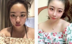 醫(yī)生說(shuō)我的鼻子需要抬高鼻梁，然后縮小鼻子