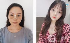 鼻梁很低，鼻翼很寬，從正面和側(cè)面看，這都是一個(gè)合適的塌鼻子
