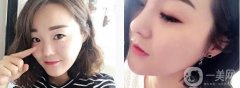 看到那種挺翹的鼻子，感覺特別好看，很立體也很襯臉