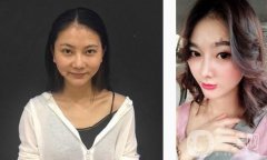 比如我的鼻子，我的鼻子，我的鼻梁都比較低，但是從正面看沒有問題，但是從