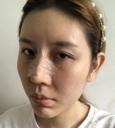 在網(wǎng)上查了很多隆鼻的資料，看到了各種鼻子類型