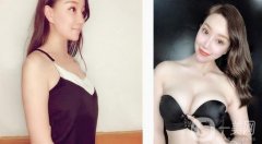 假體隆胸后一個(gè)月，現(xiàn)在有了漂亮性感的乳房，穿性感吊帶就沒壓力了